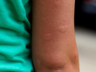 arm with multiple swollen mosquito bites